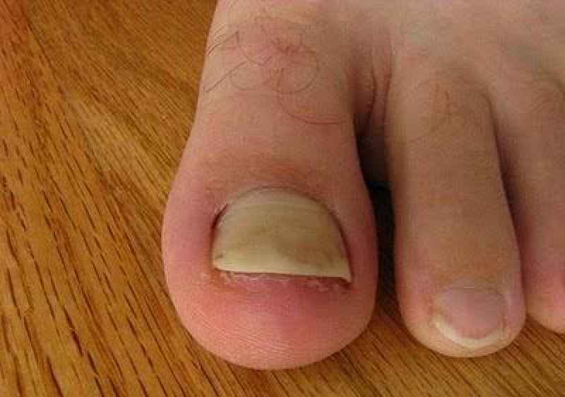 Can trauma cause thick toenails