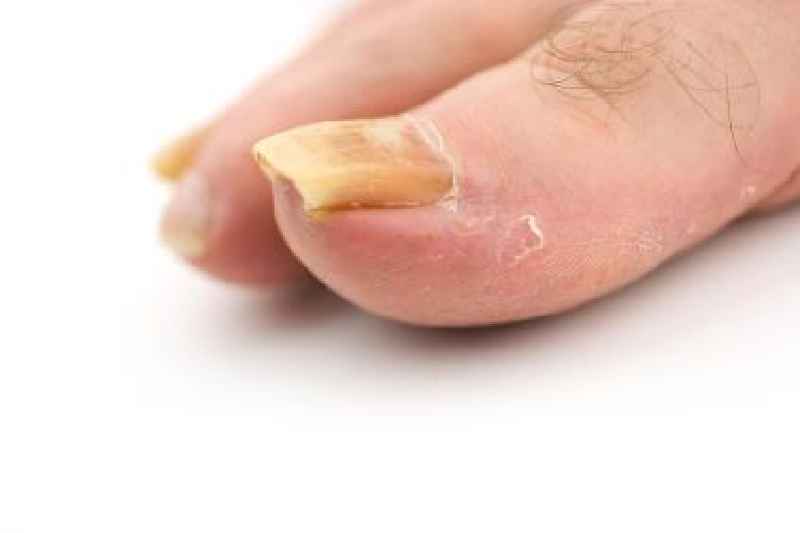 Can type 2 diabetes cause toenail fungus