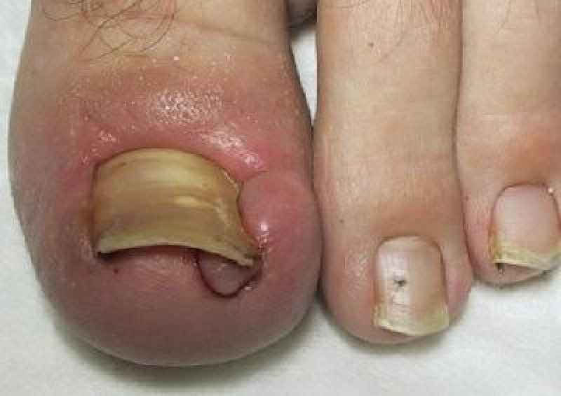 Can Urgent Care treat ingrown toenail