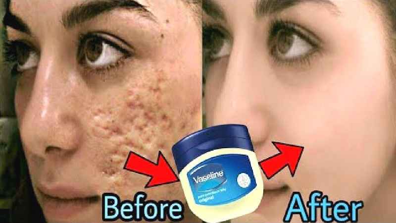 Can Vaseline petroleum jelly remove scars