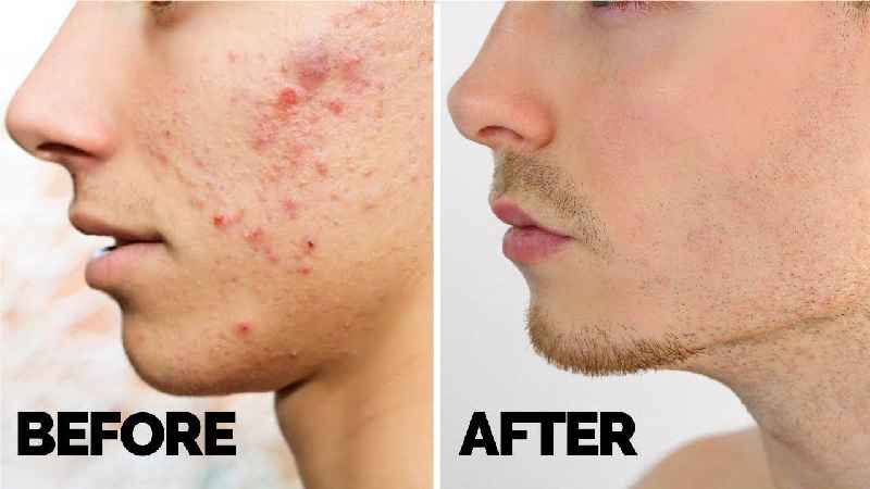 Can Vaseline remove pimples