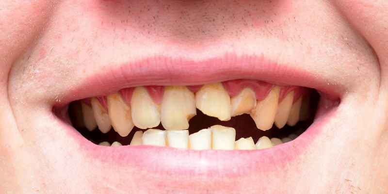 Can veneers fix rotten teeth