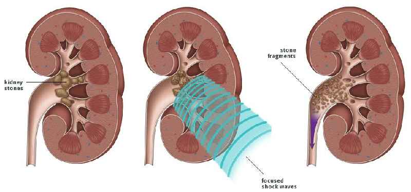 Can Voltaren gel damage kidneys