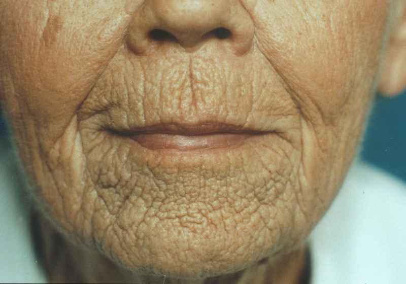 Can wrinkled skin be reversed