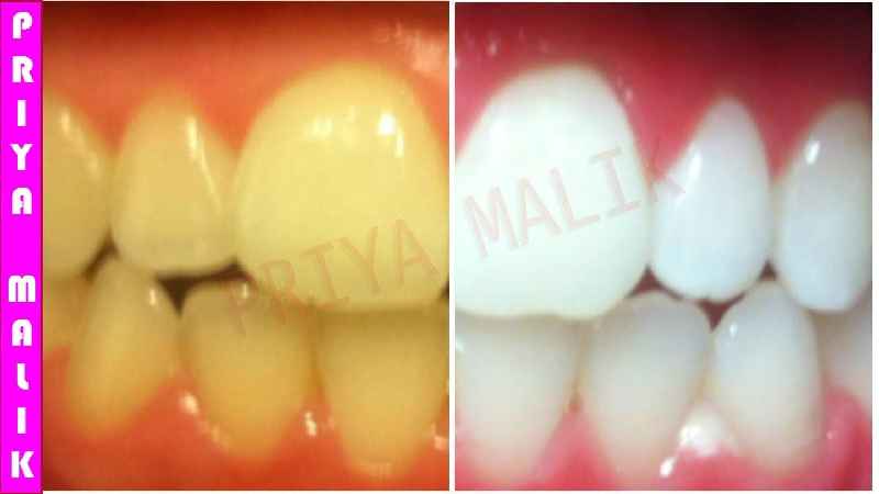Can yellow teeth become white