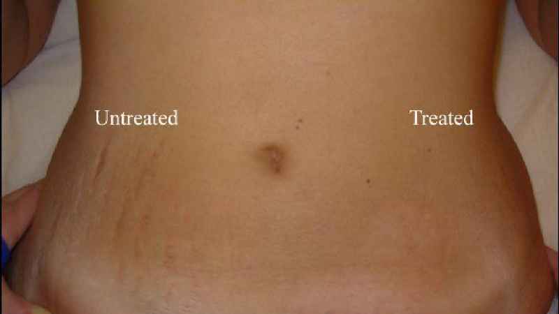 Can you 100% get rid of stretch marks