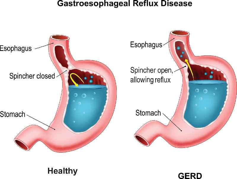 Can you damage your gastric sleeve