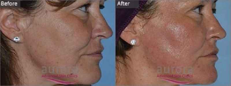 Can you Dermaplane after Microneedling