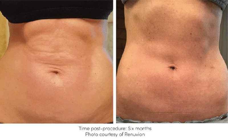 Can you do a tummy tuck under local anesthesia