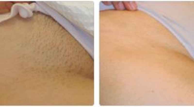 Can you do laser hair removal on your pubic area