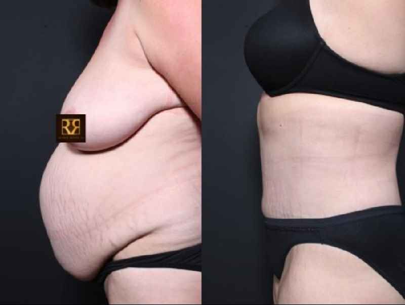 Can you get a facelift and a tummy tuck at the same time