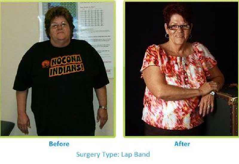 Can you get fat again after gastric bypass