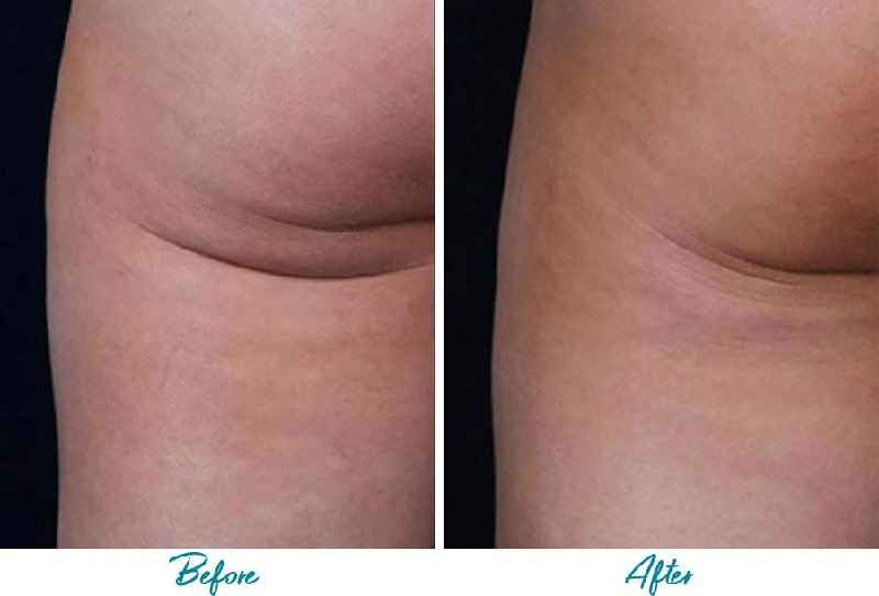 Can you get rid of cellulite with plastic surgery