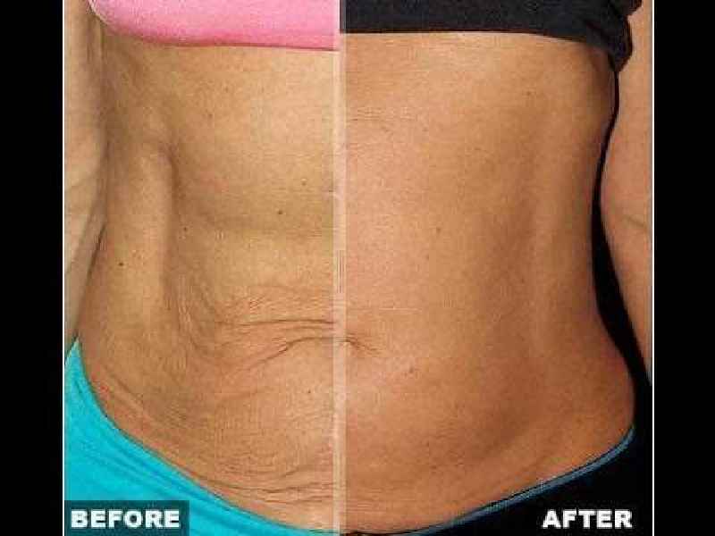 Can you get rid of loose skin without surgery