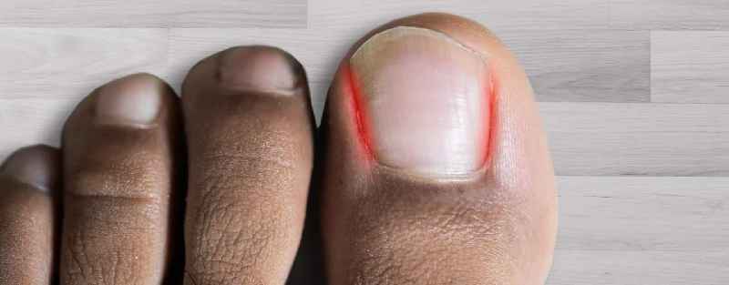 Can you get sepsis from ingrown toenail