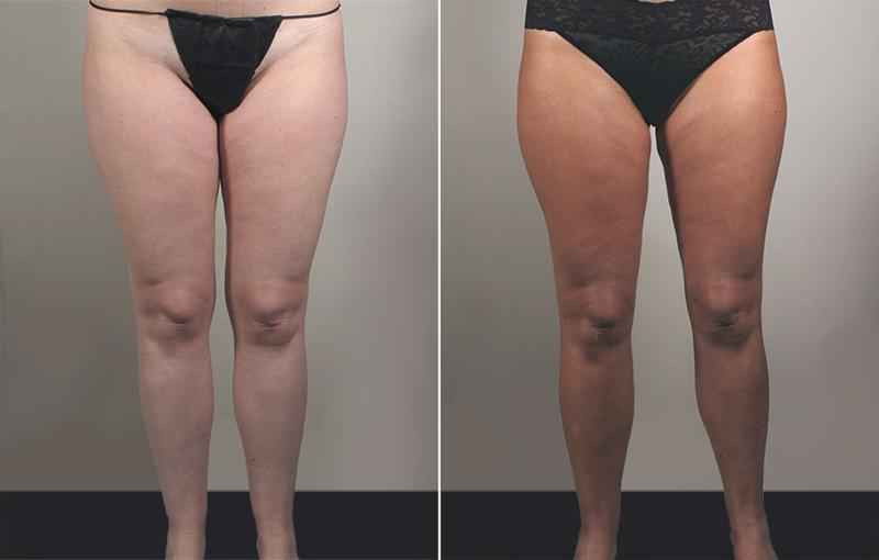 Can you get too skinny after bariatric surgery