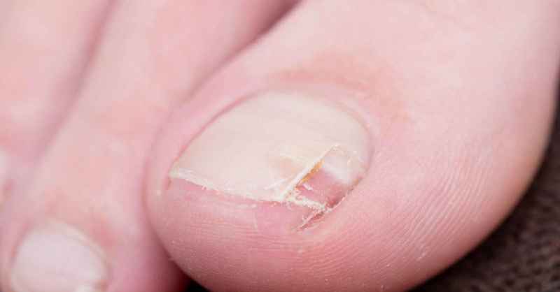 Can you glue a split nail