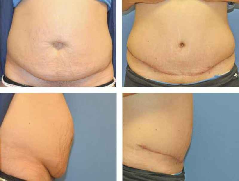 Can you have lipo and tummy tuck at the same time