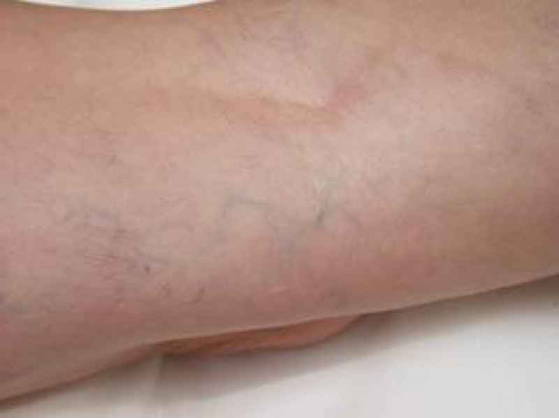 Can you have varicose vein surgery twice