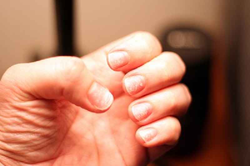 Can you heal a damaged nail bed
