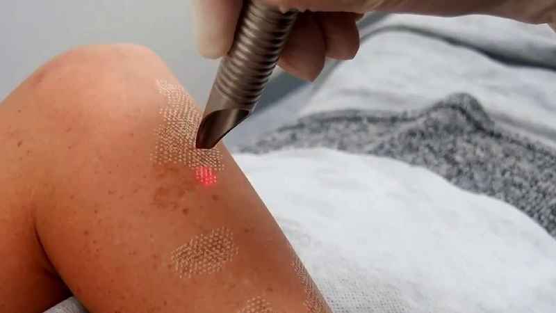 Can you moisturize after laser treatment