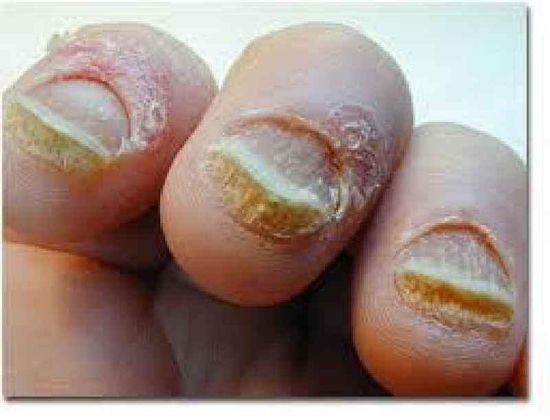 Can you permanently damage your nail bed