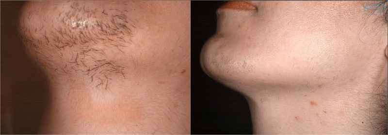 Can you pluck chin hair after laser removal