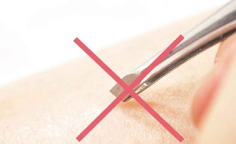 Can you poke an ingrown hair with a needle