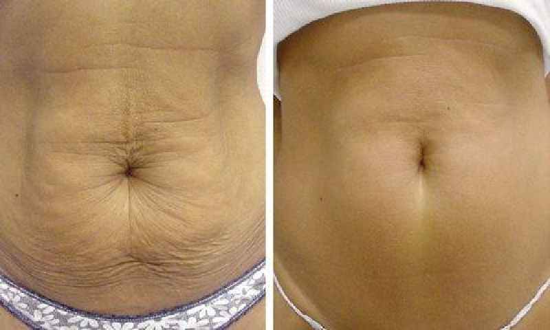 Can you really tighten loose belly skin