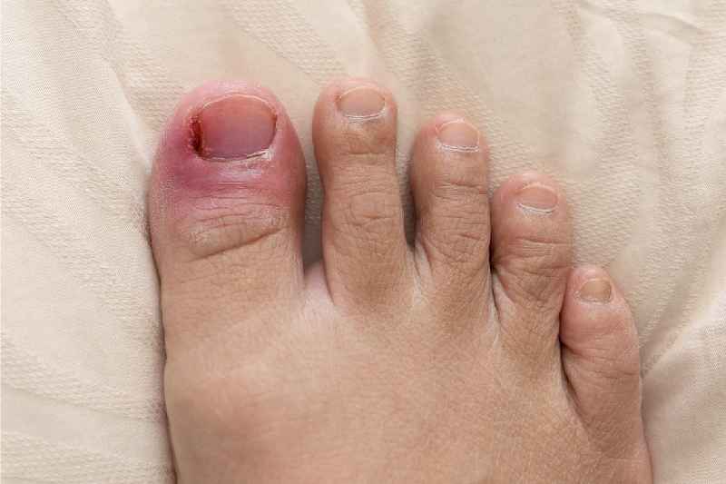 Can you redirect an ingrown toenail