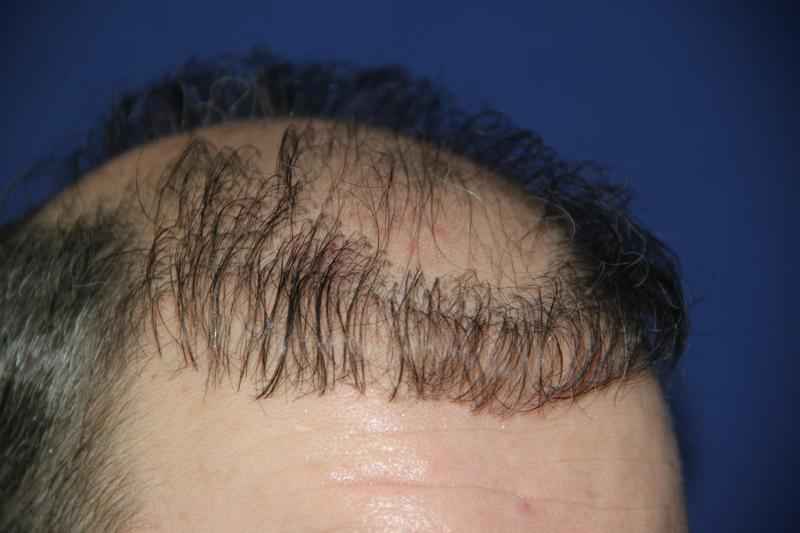 Can you regrow hair loss