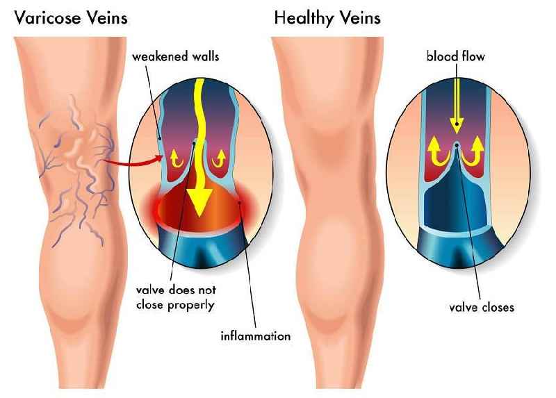 Can you reverse varicose veins naturally