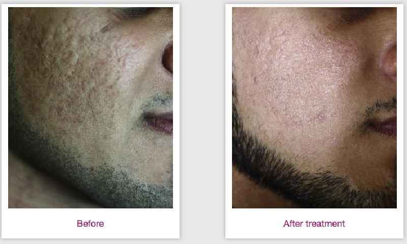 Can you see a difference after one laser hair removal treatment