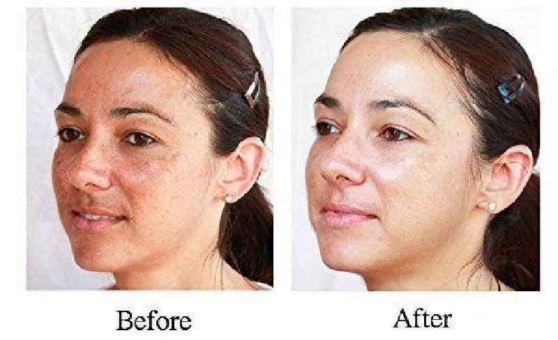 Can you see results after 1 peel