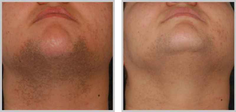 Can you shave after laser hair removal