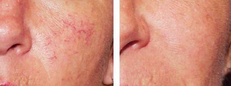 Can you shave between laser treatments