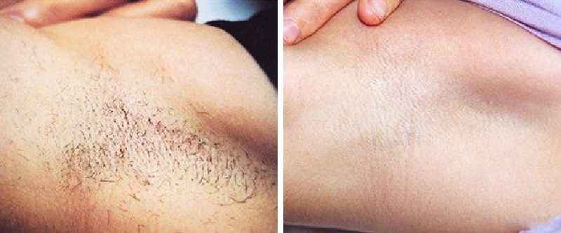 Can you shower after laser hair removal