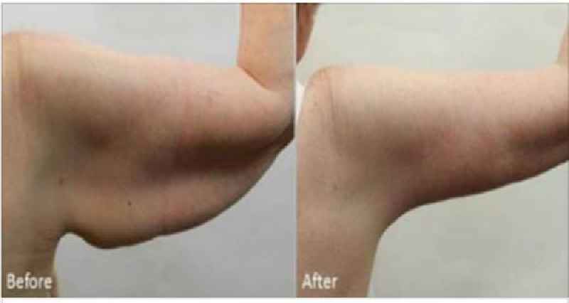 Can you tighten loose skin under arms