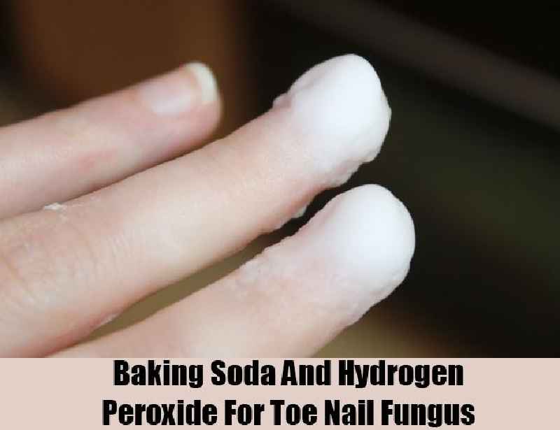 Can you treat nail fungus with hydrogen peroxide