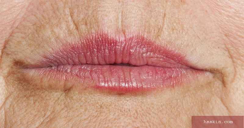 Can you use Botox for upper lip wrinkles