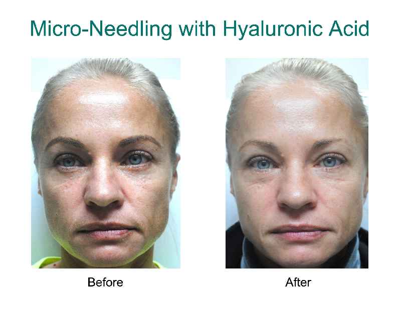 Can you use hyaluronic acid before laser removal