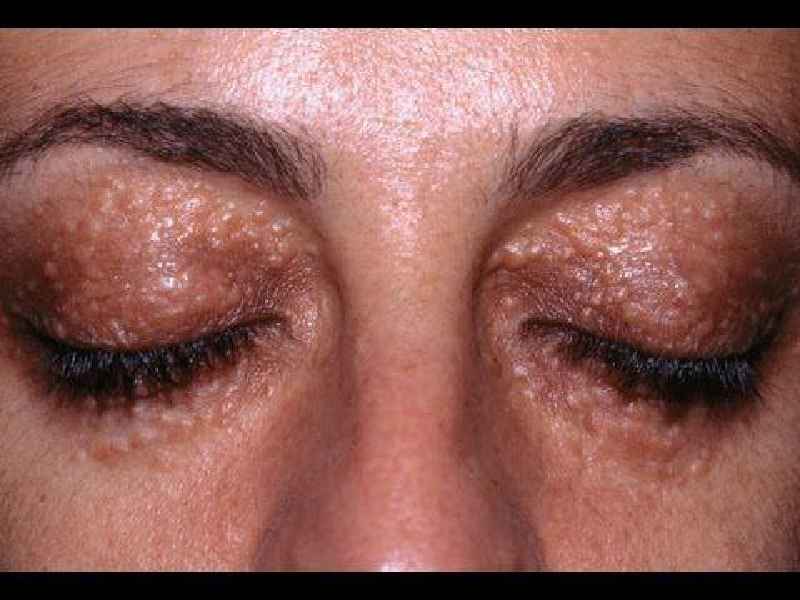 Can you use hydroquinone under eyes