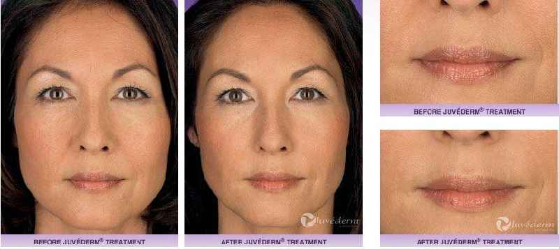 Can you use Juvederm Ultra XC under eyes