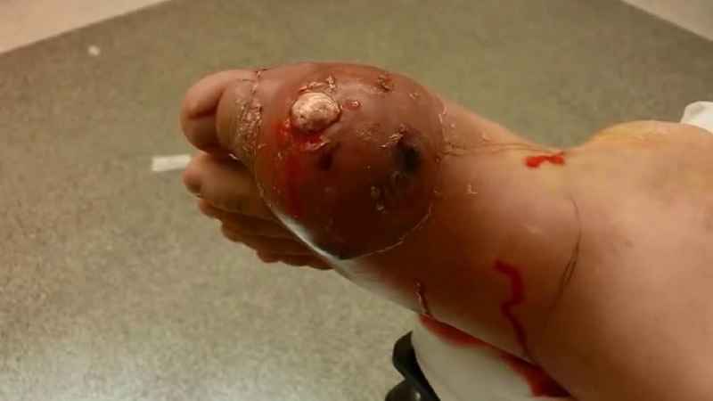 Can you walk after big toenail removal