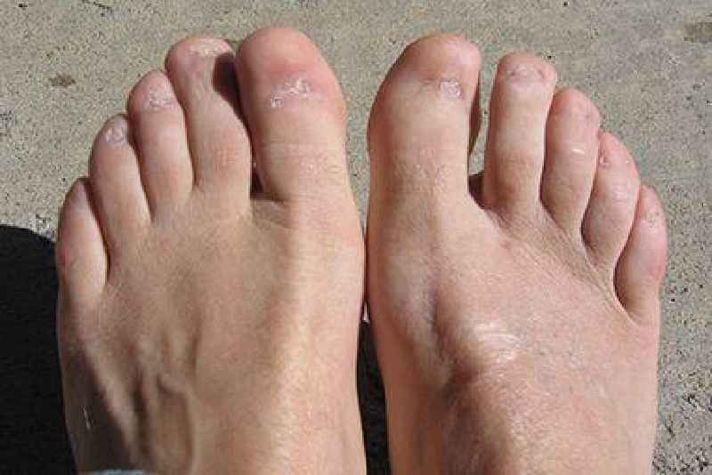 Can you walk after ingrown toenail surgery