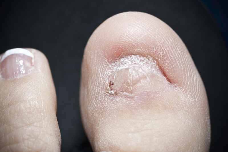Can you walk after toenail removal