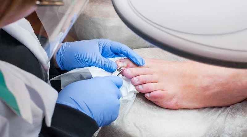 Can you wear socks after toenail removal