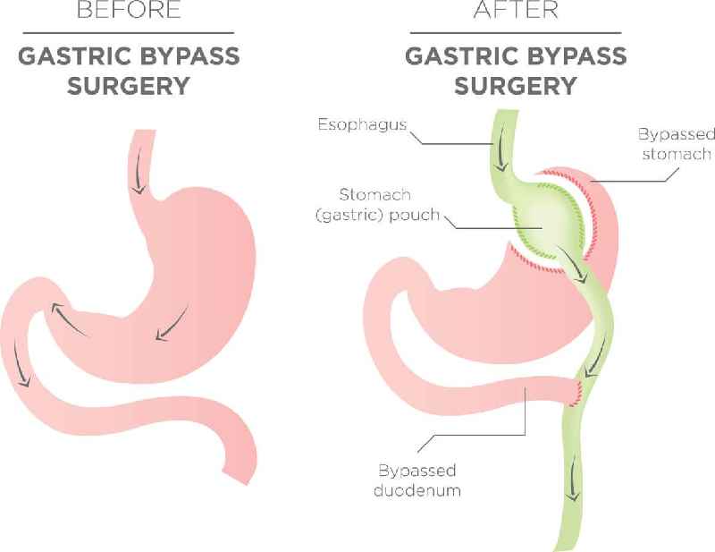 Can your stomach grow back after gastric sleeve