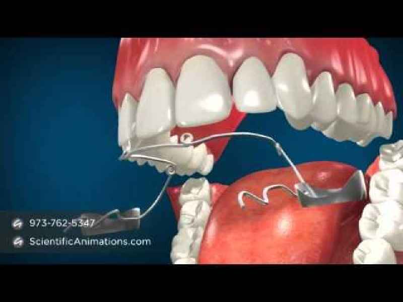 Do children's teeth straighten out