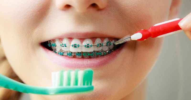 Do dental hygienist do braces